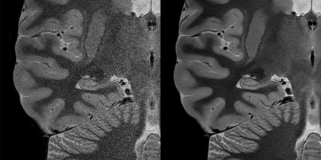 With Advanced intelligent Clear-IQ Engine (AiCE) on the premium Vantage Orian 1.5T, it is possible to see through the noise to clearly visualize the anatomical structure of the hippocampus at high resolution while maintaining tissue contrast. (Credit: Canon Medical)