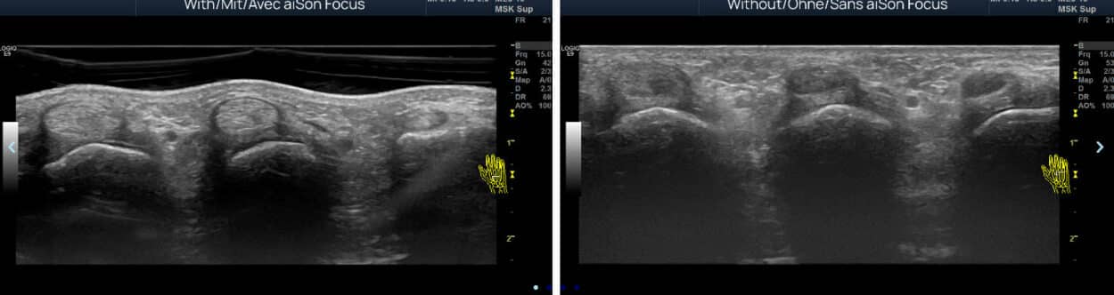 With aiSon Focus (left), without aiSon Focus (right). (Creidt: aiSon Technologies' first adaptive ultrasound pad. (Credit: aiSon Technologies)