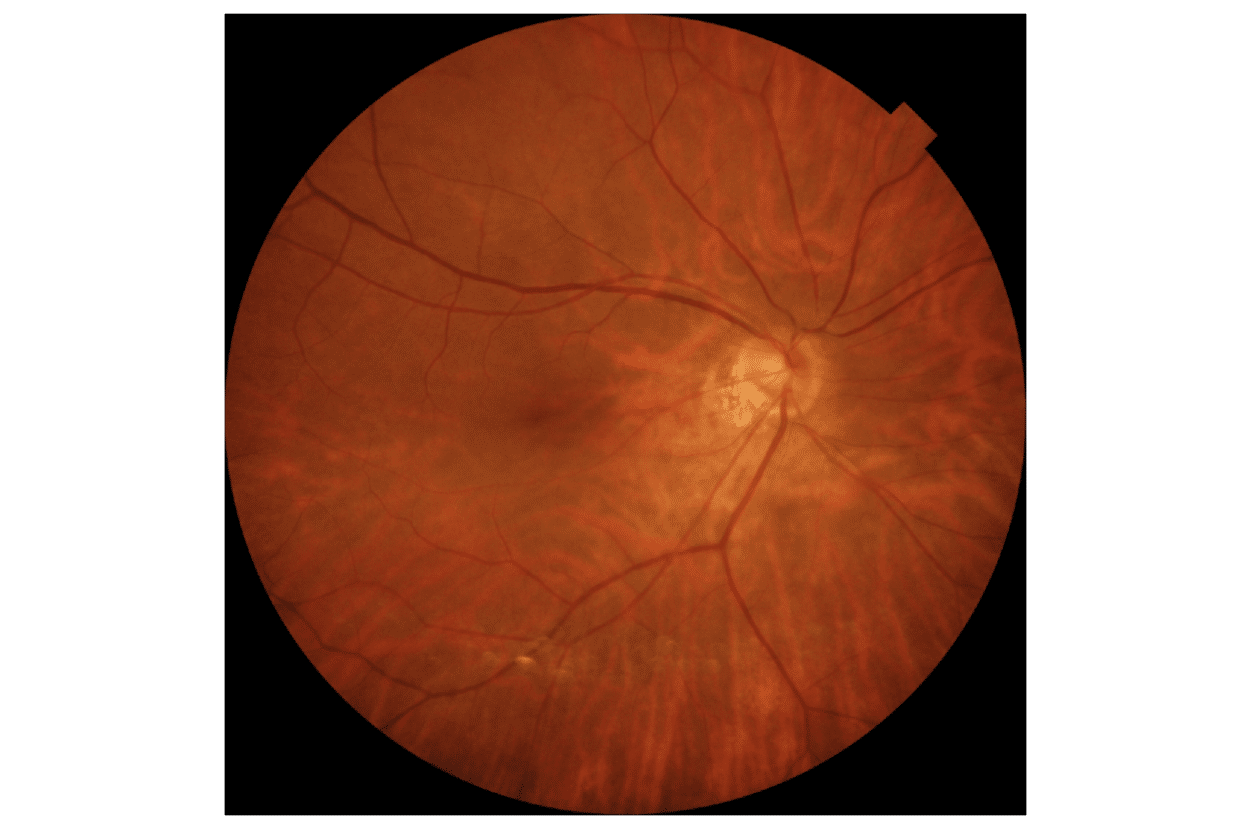Cataract (Credit: Dr. Jacob Cheng)