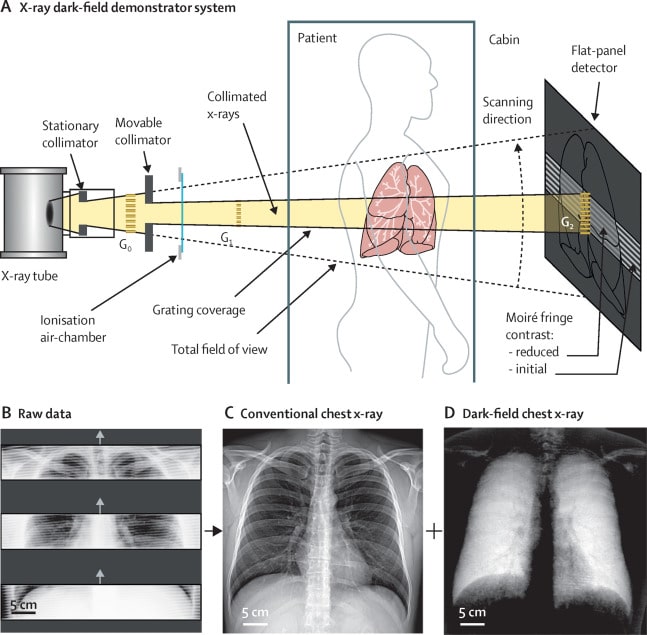 Figure 1 Schematic of the x-ray dark-field demonstrator system (A) and examples of raw detector imaging data (B), retrieved conventional chest x-rays (C), and dark-field chest x-rays (D) from the first in-human application. (Credit: The Lancet Digital Health)