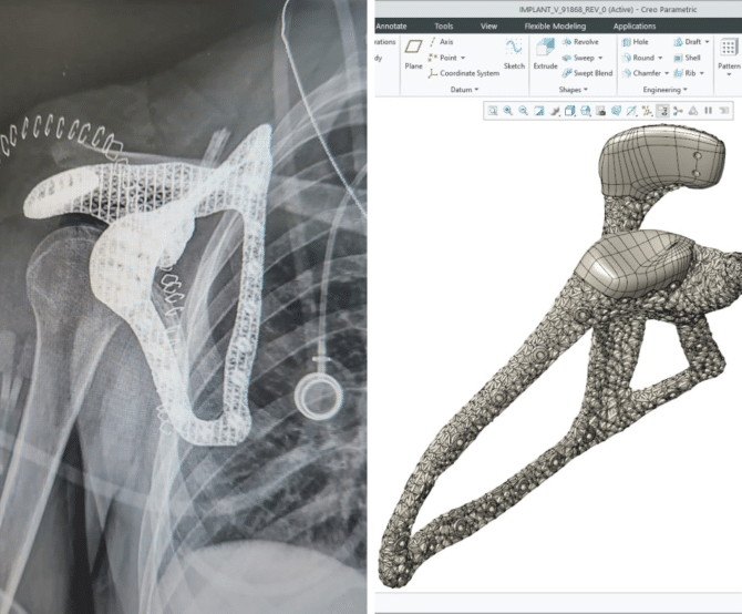 Image How Medicine Can Learn From Industry: A Cutting-Edge Scapula Implant 