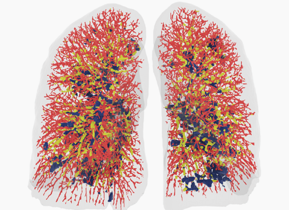 Fluidda has developed a technology called Functional Respiratory Imaging to provide substantially more insight into lung diseases and treatments for lung diseases. (Credit: Fluidda)