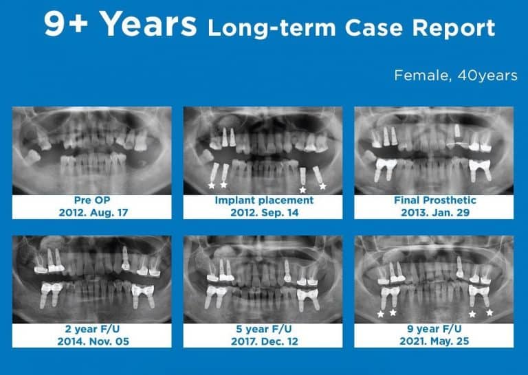 Diff Tooth Print IDS: A Focus on the Latest Innovations in Dental Implants - MedicalExpo ...