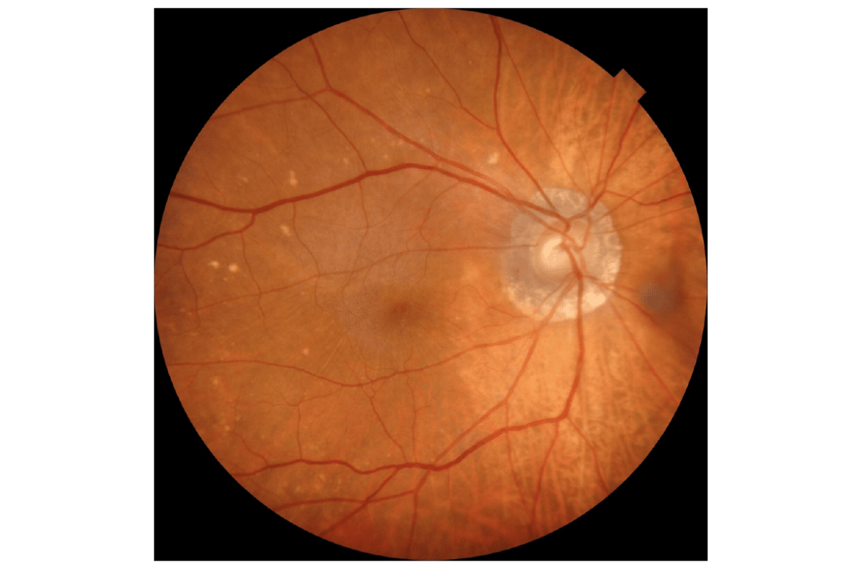 Glaucoma (Credit: Dr. Jacob Cheng)