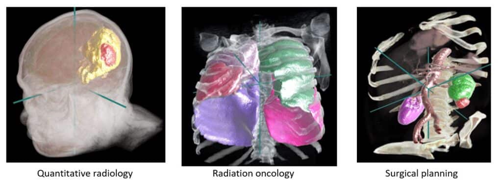 Potential applications for the InnerEye Deep Learning Toolkit include quantitative radiology for monitoring tumor progression, planning for surgery, and radiotherapy planning. (Credit: Microsoft)