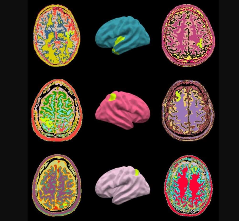 MELD FCD: Automated MRI detection of focal cortical dysplasias (FCDs). (Credit: MELD Project)