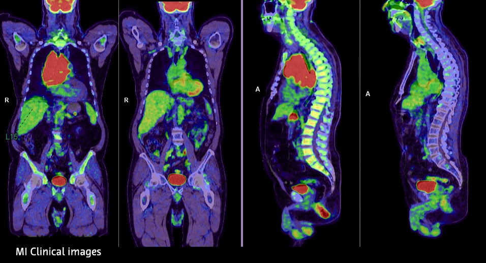 Molecular imaging includes the fields of Nuclear Medicine (NM) and Positron Emission Tomography (PET). Molecular imaging involves a signal-producing imaging agent (radiopharmaceutical or probe) that is introduced into the body, usually by injection, and an imaging device capable of detecting and using the probe’s signals to create detailed images. Courtesy of Bayer.