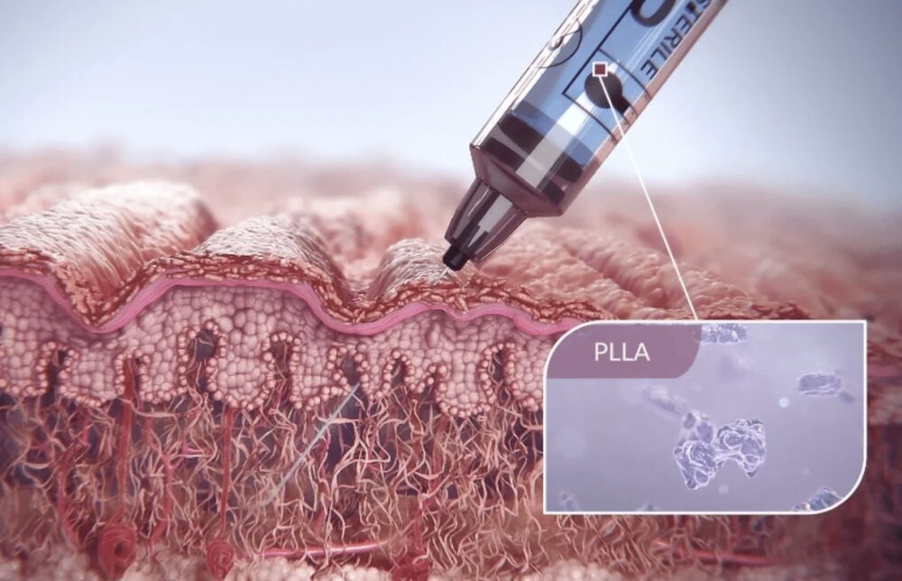 PLLA-SCA works undernearth the skin to help restore the skin's inner structure. Courtesy of Sculptra.
