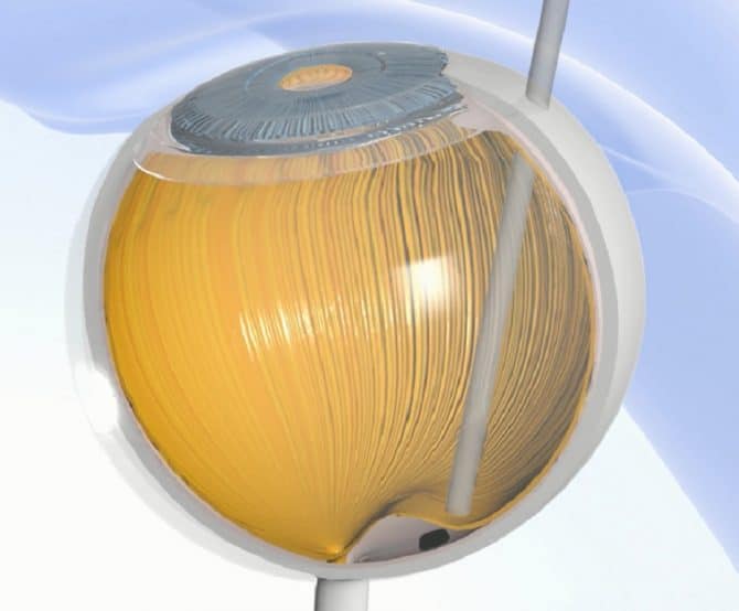 Image The Prima Implant Gives Hope of Sight Restoration to the Partially Blind Patients 