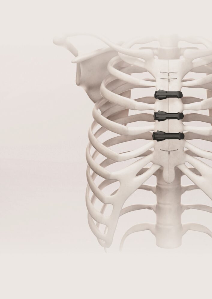 Multi-axis stability. Courtesy of Neos Surgery.
