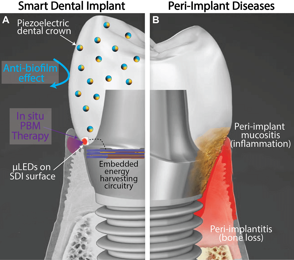 A "smart" dental implant could improve upon current devices by employing biofilm-resisting nanoparticles and a light powered by biomechanical forces to promote health of the surrounding gum tissue. (Credit: Courtesy of Albert Kim)