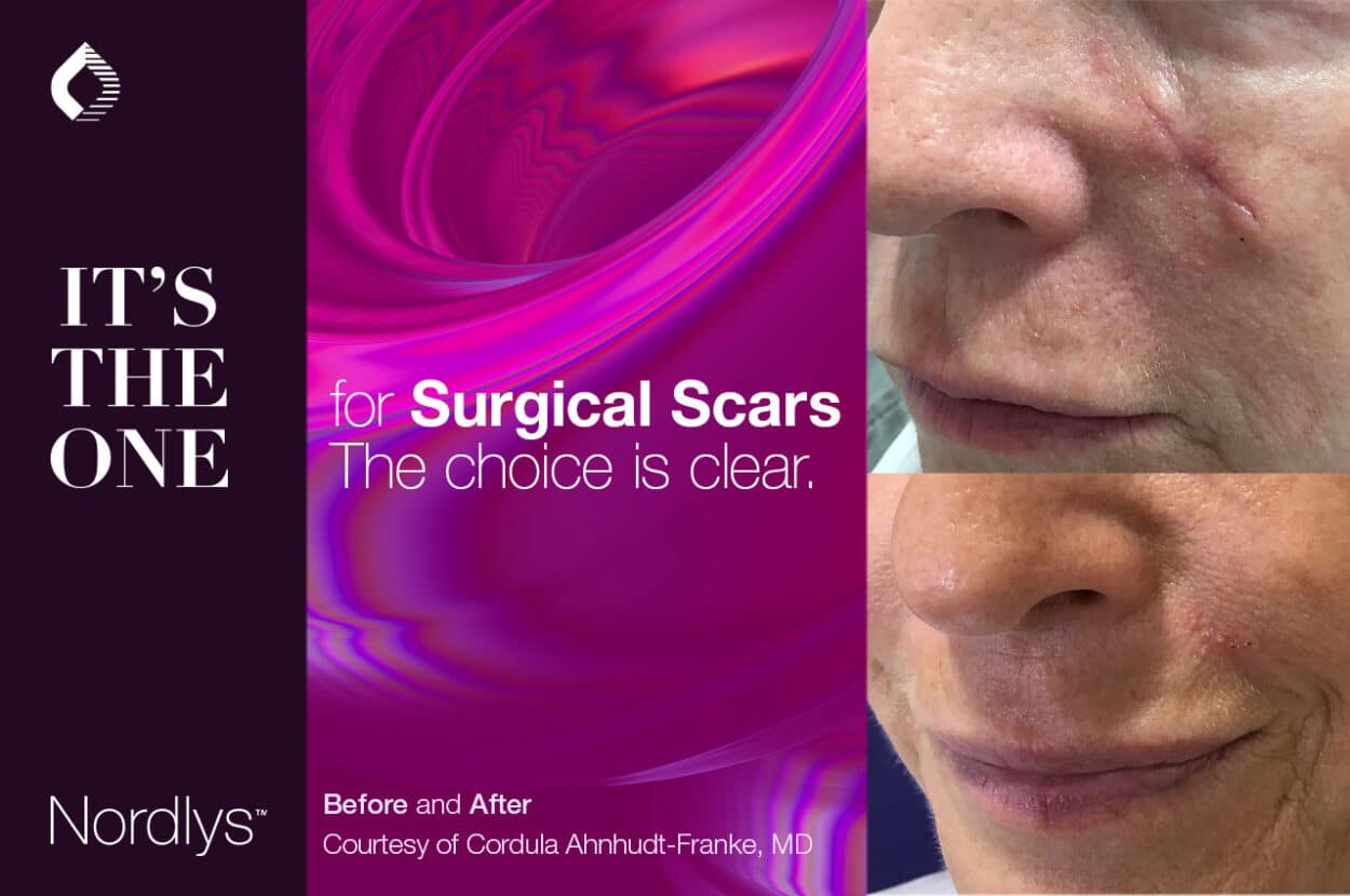 SPONSORED. Safe and Effective NonAblative Laser Treatment of Scars