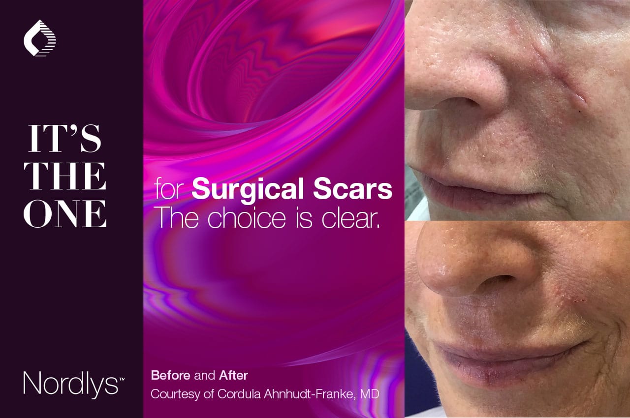 SPONSORED. Safe and Effective NonAblative Laser Treatment of Scars