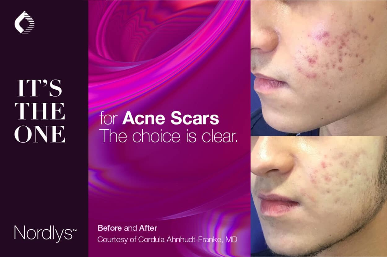 SPONSORED. Safe and Effective NonAblative Laser Treatment of Scars MedicalExpo eMagazine