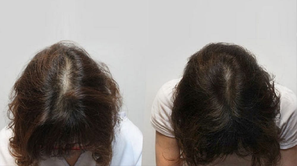 Hair before and after treatment. (Credit: Kerastem)