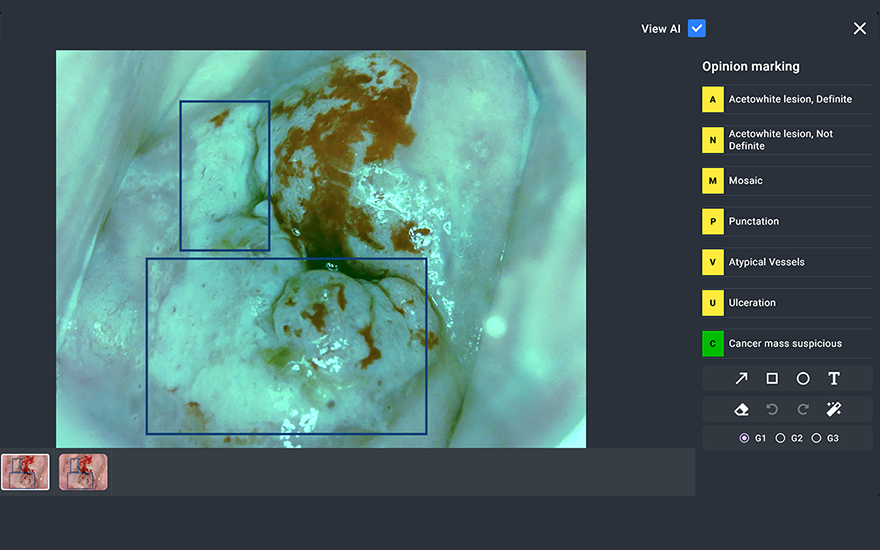 Cerviray AI. Courtesy of AIDOT Inc.