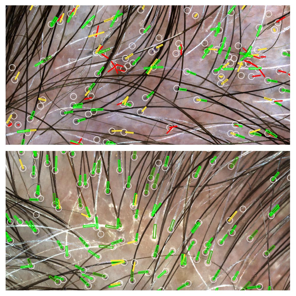 Hair before and after treatment. (Credit: Kerastem)