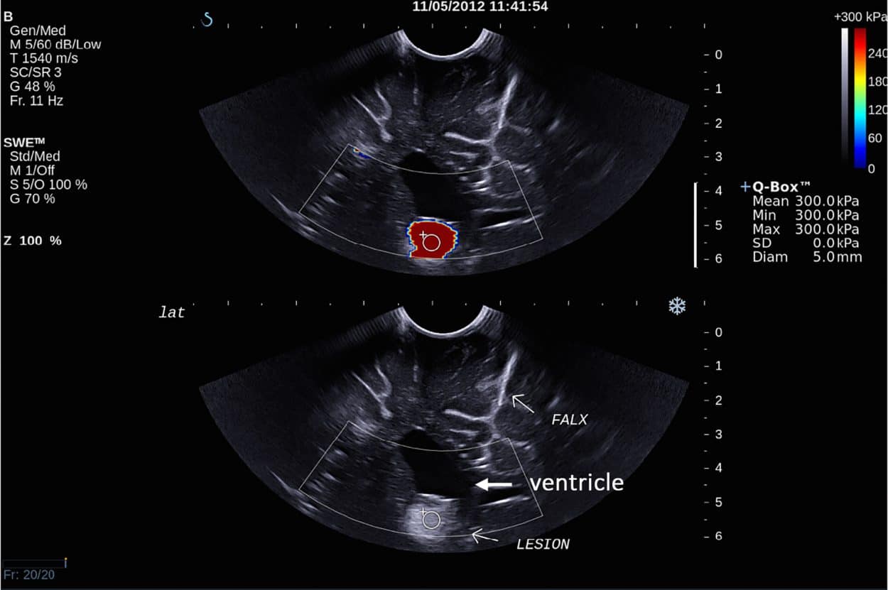 Intra-operative SWE for Patient 7 showing the tumor lying under the ventricles. The adjacent deep grey matter did not have any SWE signal. This scan was acquired using the sector probe (SE12-3) insonating in the coronal plane. The histology of this lesion is subependymal giant cell astrocytoma (Credit: SEGA).