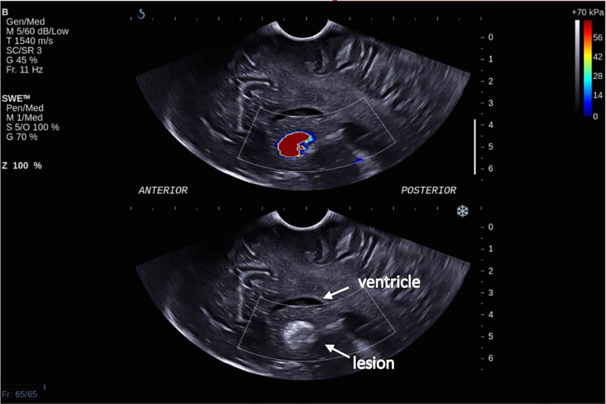 Intra-operative SWE for Patient 8 showing the tumor lying under the ventricles at a depth of 5 cm from the transducer. There was a lack of SWE signal in the adjacent brain. This scan was acquired using the sector probe (SE12-3) insonating in the sagittal plane. The histology of this lesion again is subependymal giant cell astrocytoma. (Credit: SEGA)