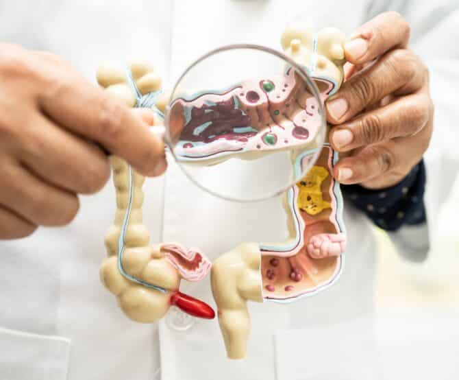 Image ABIVAX’s New Therapy for Ulcerative Colitis Gains Attention