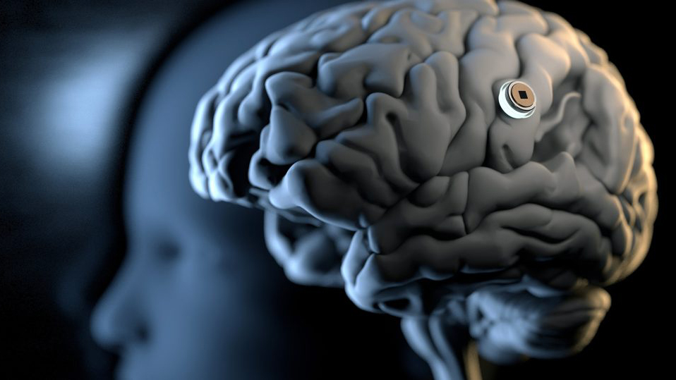 From Implants to Nanoparticles: The Next Wave of Brain-Computer Interfaces