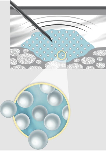 As the gel carrier breaks down, a firm network of collagen fibers form.1,4,6* Then, the formed collagen and elastin replaces the correction provided by the gel carrier, smoothing lines and promoting renewed skin structure. Courtesy of Radiesse.