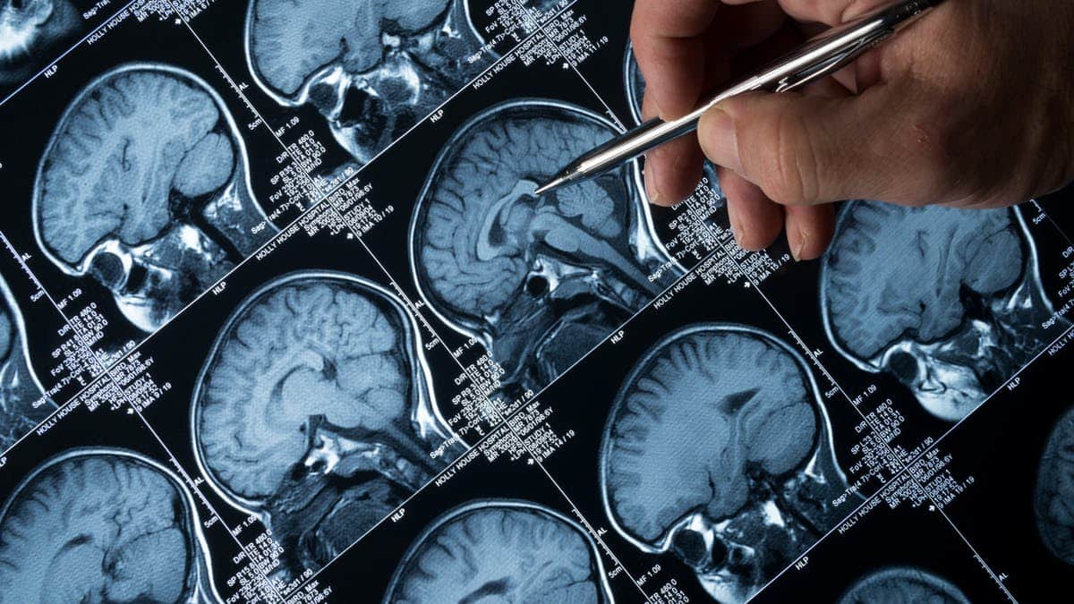 People with suspected Alzheimer’s disease first undergo a clinical evaluation by a neurologist, including a cognitive screening test, an in-depth neuropsychological evaluation, standard blood work, structural brain imaging (CT or MRI), etc. (Credit: iStock/Haydenbird)