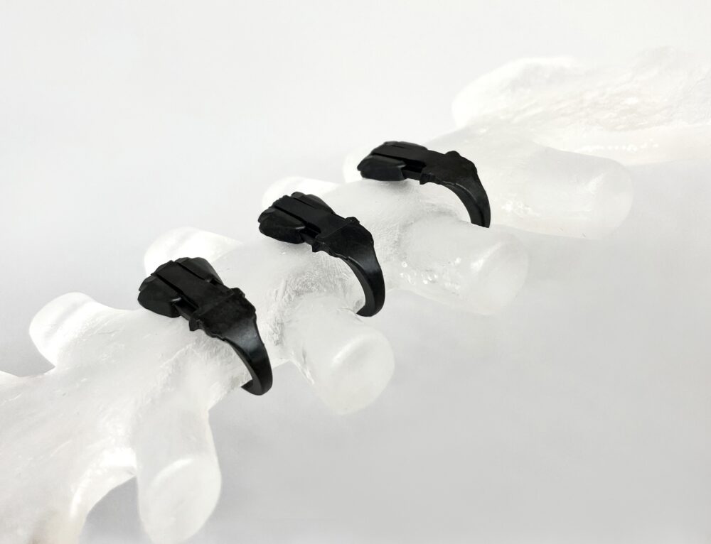 Carbon fiber fixation. Courtesy of Neos Surgery.