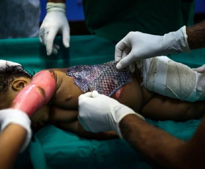 Image Doctors Turn to the Natural World to Help Cure Skin Wounds